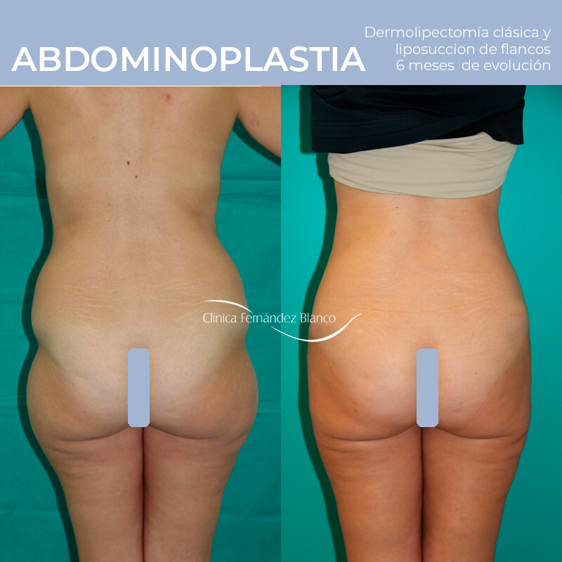 Before and After Result